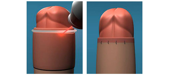 中山切包皮，中山包皮环切手术，中山东方男科医院