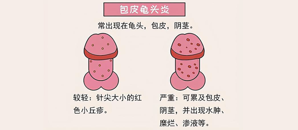 龟头炎常见症状有哪些?
