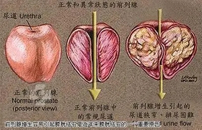 前列腺增生应该怎么预